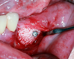 Особенности применения аутогенных костных трансплантатов и индивидуальных аллогенных костных имплантатов