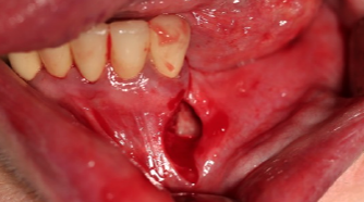 Особенности применения аутогенных костных трансплантатов и индивидуальных аллогенных костных имплантатов