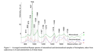 Figure 1 – Averaged normalized Raman spectra of mineralized and demineralized samples of bioimplants, taken from cadaverous (1,4) and antemortem (2,3) bone tissue