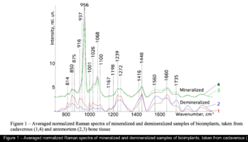  Averaged normalized Raman spectra of mineralized and demineralized samples of bioimplants, taken from cadaverous (1,4) and antemortem (2,3) bone tissue