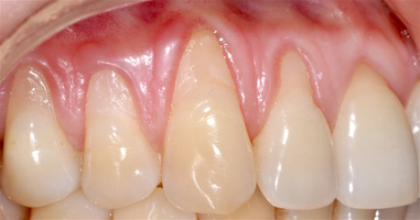Рис. 1б. Зубы 1.5-1.1