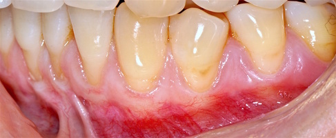 Рис. 1г. Зубы 3.6-4.1