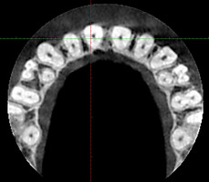 Рис. 2а. Аксиальный срез верхней челюсти