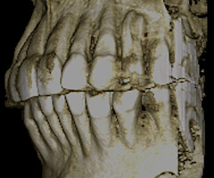 Рис. 2г. 3D-модель верхней челюсти