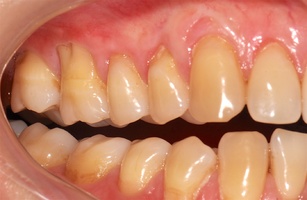 Рис. 6г. Через 8 месяцев