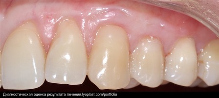 Рис. 6б. Через 9 месяцев