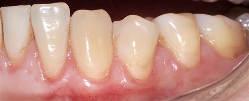Рис. 6з. Через 12 месяцев