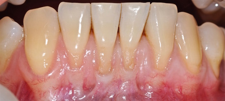 Рис. 6и. Во фронтальном участке нижней челюсти до начала лечения