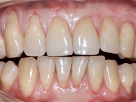 Рис. 6й. Через 12 месяцев