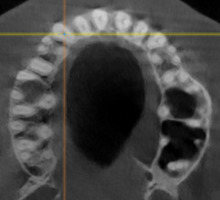Рис. 7а. Аксиальный срез верхней челюсти
