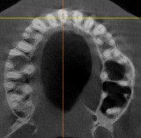 Рис. 7б. Сагитальный срез в области зуба 1.1