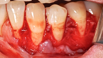 Рис. 4а. Дизайн разреза и отслаивание слизисто-надкостничного лоскута (СНЛ)