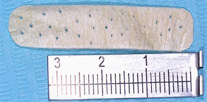 Рис. 4в. Моделированный трансплантат пластического материала
