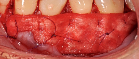 Рис. 4д. Фиксация ТМО в области рецессии
