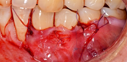 Рис. 4е. Ушивание операционной раны