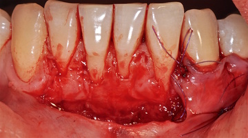 Рис. 4ж. Дизайн разреза и отслаивание СНЛ в области передних зубов нижней челюсти