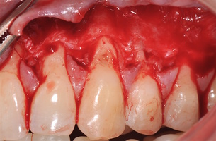 Рис. 5б. Отслаивание СНЛ
