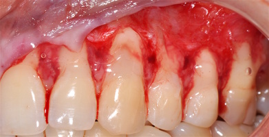 Рис. 5в. Химическая обработка поверхности корней зубов