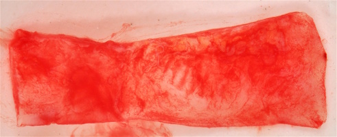 Рис. 5г. Забранный аутотрансплантат с неба