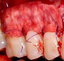 Рис. 5л (левая половина). Фиксация аутотрансплантата и ТМО (dura mater) в области рецессии
