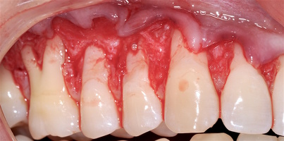Рис. 5к. Поверхности корней зубов после машинной обработки