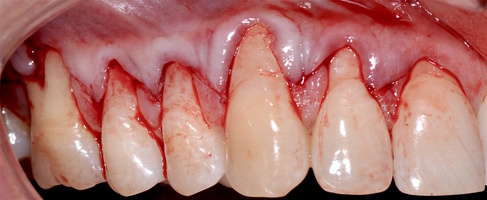 Рис. 5з. Фиксация аутотранс- плантата и ТМО (dura mater) в области рецессии