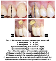 Рис. 1. Исходные значения параметров рецессий: а) измерение ГР 1.4 зуба, б) измерение ГР 1.6 зуба, в) измерение ШКД в области 1.4 зуба, г) измерение ШКД в области 1.5 зуба