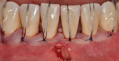 Фиксация слизисто-надкостничного лоскута композитными швами к зубам