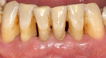 Шинированные зубы во фронтальном участке нижней челюсти