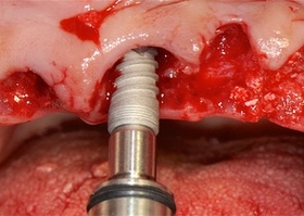 Операция 9. Удаление зуба совместно с имплантацией в крупную альвеолу