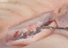 Операция 10. Имплантация в первом типе костной ткани. Хирургическая подготовка