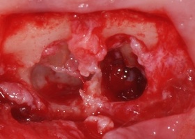 Операция 25. Резекция верхушки корня зуба, цист-эктомия; пластика Mix-MAX