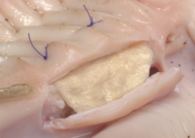 Операция 28. Утолщение биотипа десны перед ортодонтическим лечением
