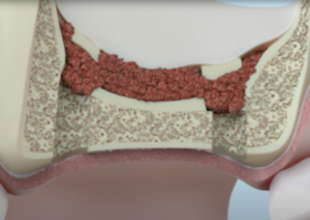 Операция 12. Поднятие дна синуса с пластикой в области одного зуба на высоту до 5 мм