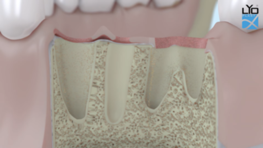Операция №18 Пластика альвеолярного отростка челюсти по ширине методом HTP с каркасными винтами