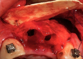 Оценка влияния остео-пластических материалов на регенерацию костной ткани после операции цистэктомии с резекцией апекса корня