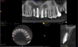 Рис. 1. Гистограмма распределения плотности на дентальной компьютерной томографии фронтального отдела верхней челюсти