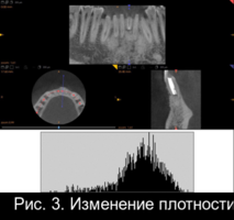 Рис. 3. Изменение плотности костной ткани в области дефекта на следующий день после операции РВК, через 3 и 6 месяцев.