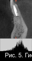 Рис. 5. Гистограммы распределения плотности через 3 месяца после операции РВК (б)