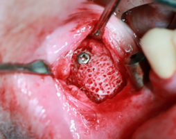 Особенности применения аутогенных костных трансплантатов и индивидуальных аллогенных костных имплантатов