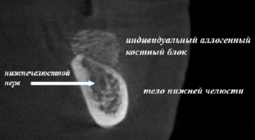Особенности применения аутогенных костных трансплантатов и индивидуальных аллогенных костных имплантатов