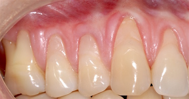 Рис. 1а. Зубы 1.6-1.2