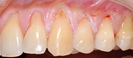Рис. 1в. Зубы 2.1-2.6