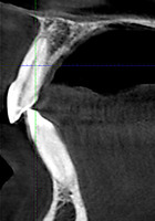 Рис. 2б. Сагитальный срез в области 1.1 зуба