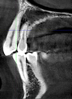 Рис. 2в. Сагитальный срез в области