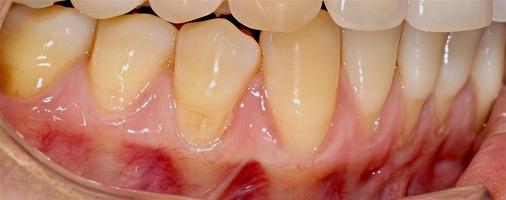 Рис. 6д. В третьем сегменте до начала лечения