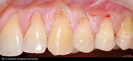 Рис. 6а. Во втором сегменте до начала лечения