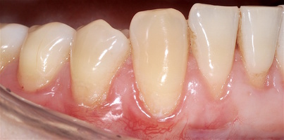 Рис. 6е. Через 12 месяцев