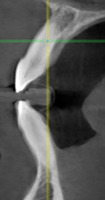 Рис. 7г. 3D-модель верхней челюсти