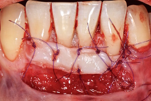 Рис. 4з. Фиксация аутотрансплантата в области рецессии